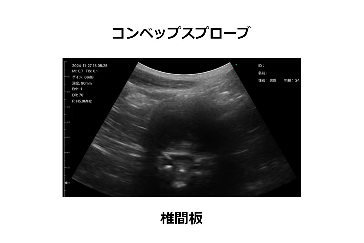 コンベップスプローブ　画像　椎間板