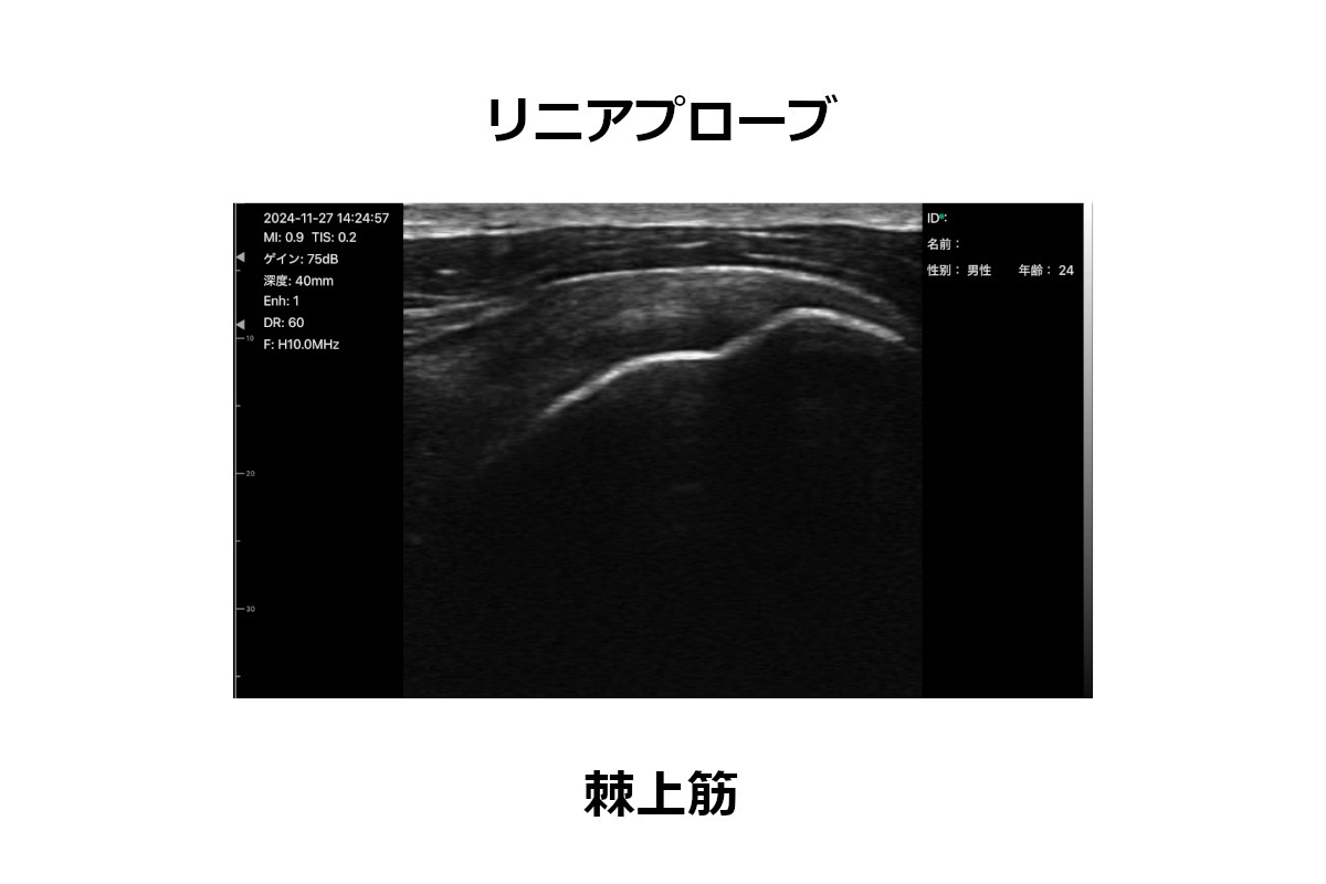 リニアプローブ　画像　棘上筋